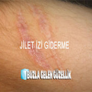jilet-izi-giderme