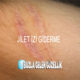 jilet-izi-giderme